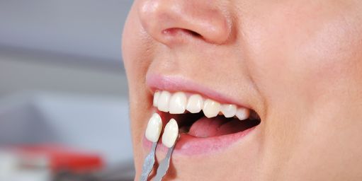 beneficio-de-las-carillas Beneficio de las carillas dentales