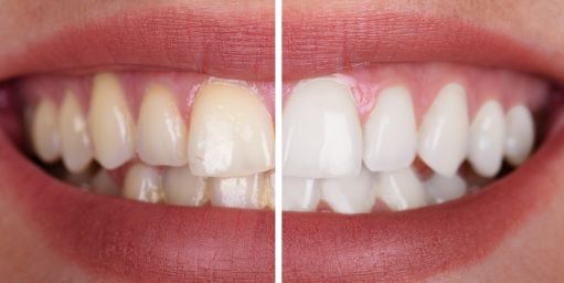 blanqueamiento-dental-granada Blanqueamiento dental Granada antes y después