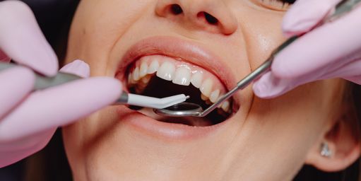 tratamientos-para-encias-mas-esteticas-granada Tratamientos para encías más estéticas